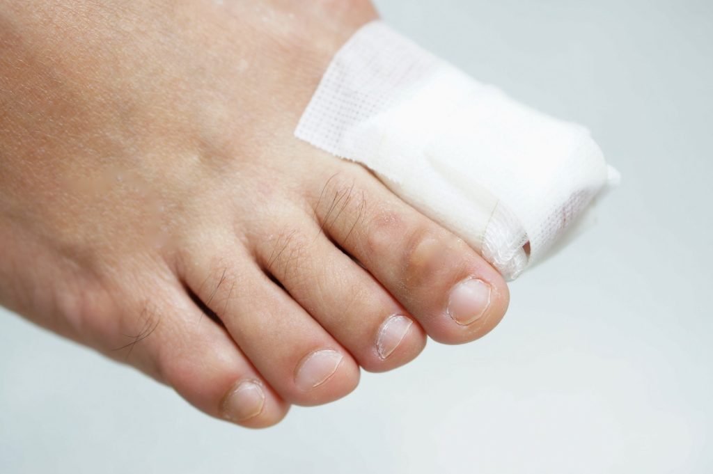 What To Know About Ingrown Toenail Surgery